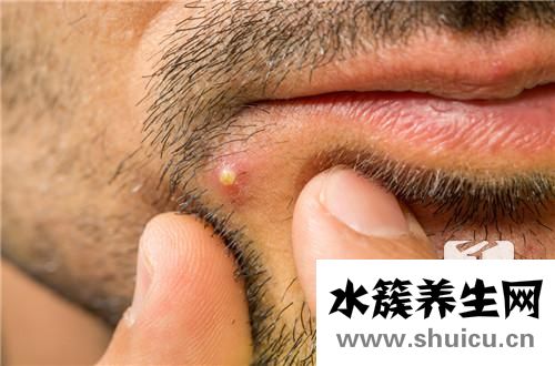 帶狀皰疹后續(xù)治療