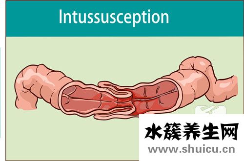 十二指腸淤滯癥