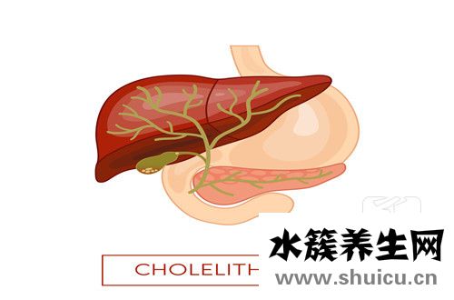 膽結(jié)石排出