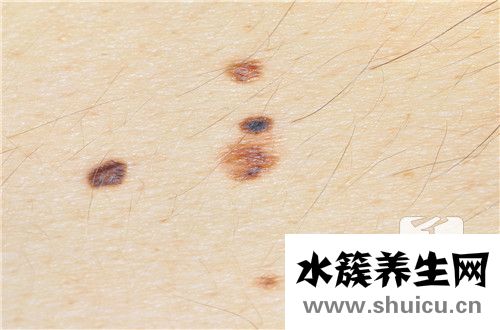 皮膚黑點