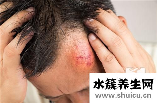 頭撞了個包消腫