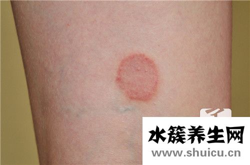 身上起紅點不痛不癢