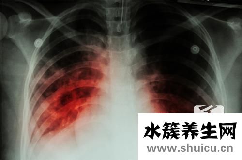 肺結(jié)核是傳染病嗎