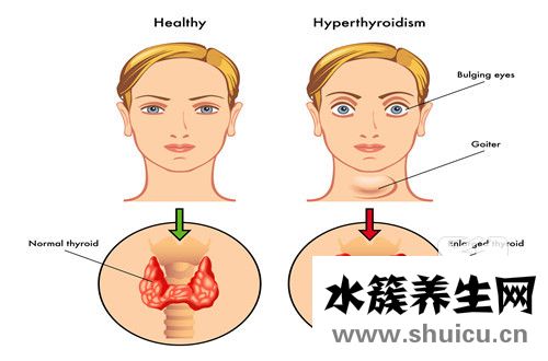 懷孕會引起甲亢