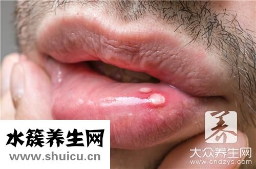 口瘡原因