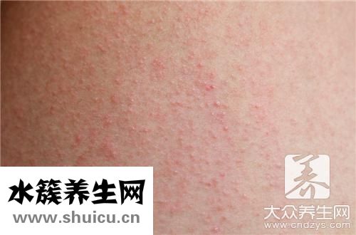 長濕疹是什么原因