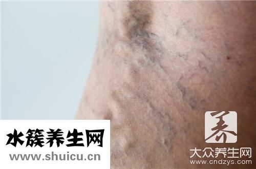 小腿血管鼓起
