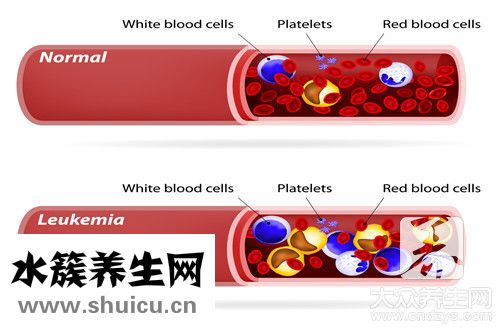 血小板增多癥能自愈嗎