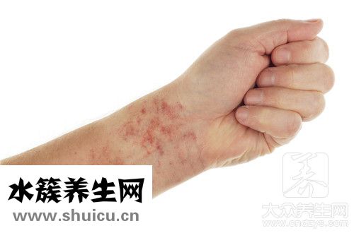 紫癜早期癥狀同