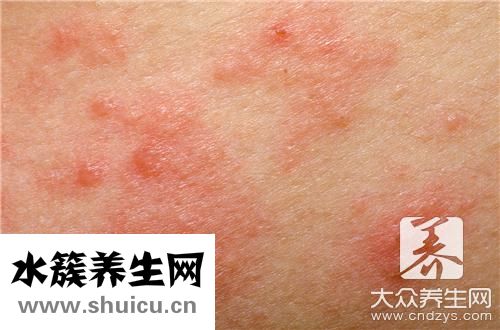 臉上長(zhǎng)皰疹