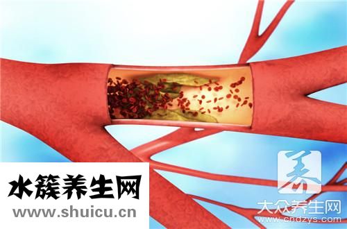 血管斑塊能消除嗎