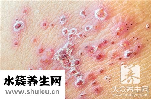 尋麻疹吃什么食物調理