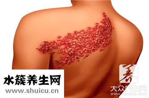 帶狀皰疹最快治療方法