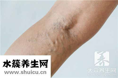 靜脈曲手術后幾天能走