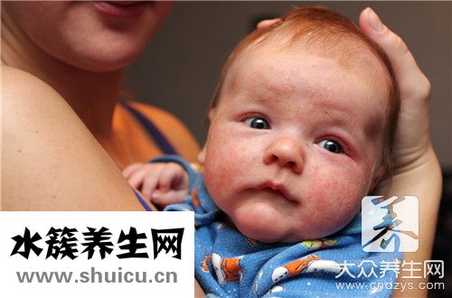 濕疹干燥脫皮代表什么