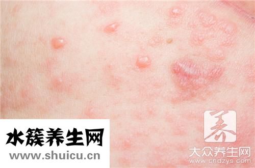 脫敏針一針多少錢