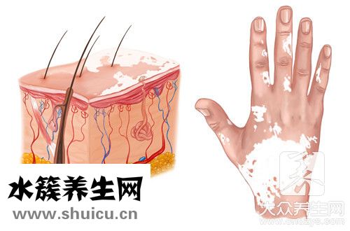 扁平苔蘚治療方法