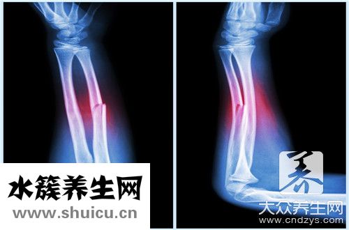 第五跖骨骨折走路早了