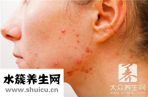 玫瑰痤瘡治療方法