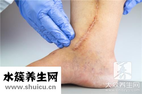 去除疤痕簡單方法