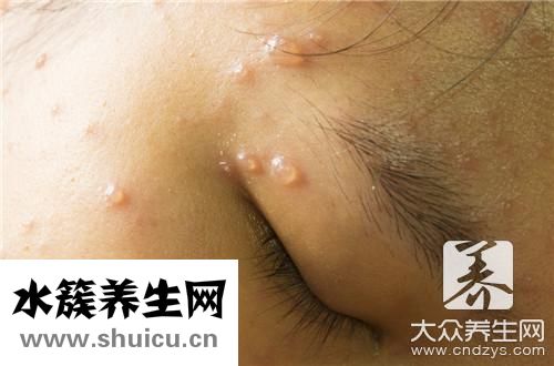 水痘坑修復(fù)