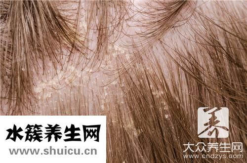 頭皮屑多且大塊還結痂