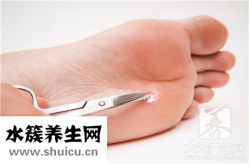 扁平疣會傳染嗎