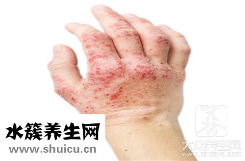 手部濕疹和手癬區(qū)別