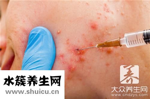 濕氣重臉上長痘痘