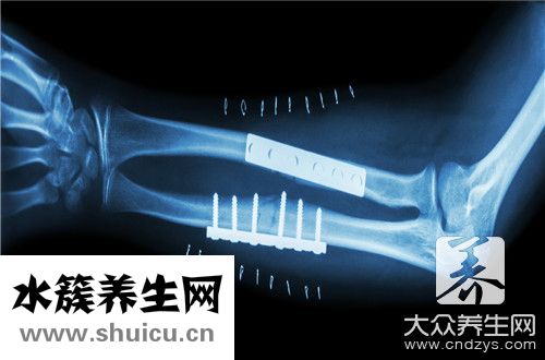 骨折需要忌口東西