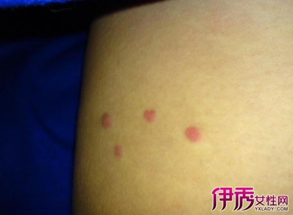 hiv初期淋巴腫大位置圖腿部(hiv初期淋巴腫大位置圖)