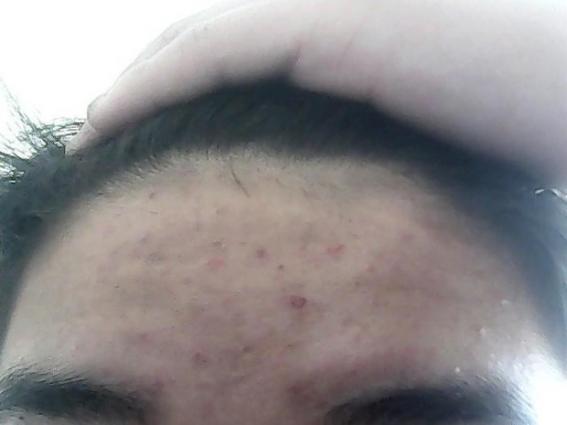 小弟外皮上面長了痘痘癢怎么回事(小弟外皮上面長了痘痘)