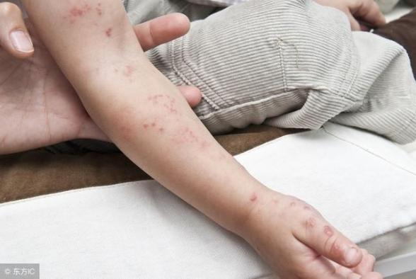 腳底汗皰疹圖片和癥狀圖片(汗皰疹圖片和癥狀圖片)