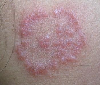 頭皮神經性皮炎的癥狀表現(神經性皮炎的癥狀表現)