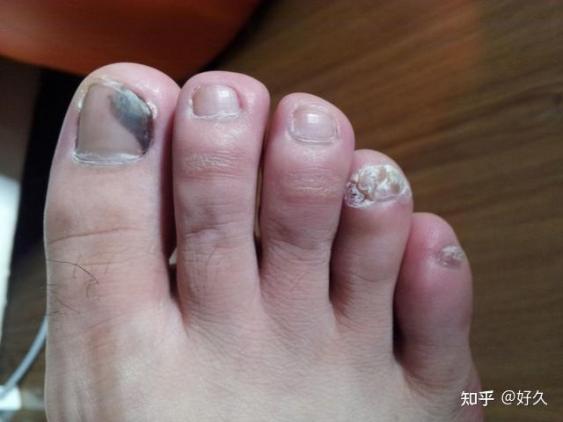 灰指甲最好的外用藥膏排名榜（灰指甲最好的外用藥膏）