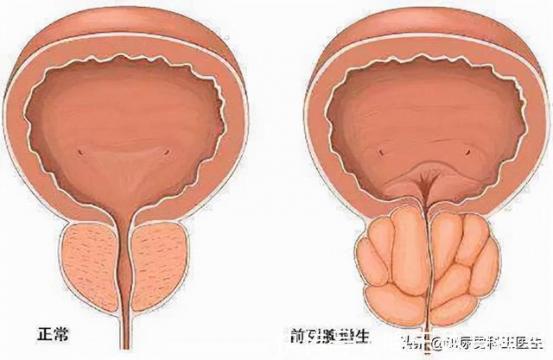 前列腺鈣化是怎么回事需要治療嗎28歲(前列腺鈣化是怎么回事需要治療嗎)