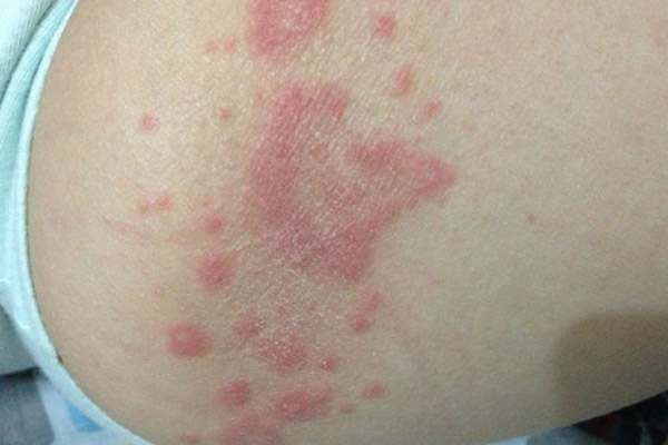 大腿紅斑圖片和癥狀圖片(紅斑圖片和癥狀圖片)