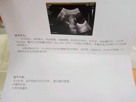 卵巢囊腫的癥狀是什么樣的(卵巢囊腫的癥狀10大前兆)