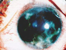 角膜炎圖片初期和圖片正常眼睛對比(角膜炎圖片初期)