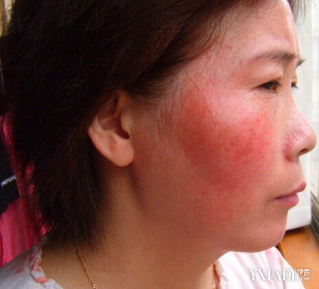 臉部皮膚過敏癥狀圖片女(臉部皮膚過敏癥狀圖片)