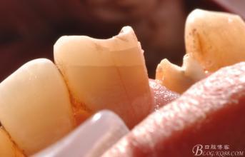 牙齒痛怎么快速止痛用鹽(牙齒痛怎么快速止痛)