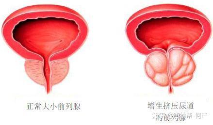 老年人前列腺肥大怎么治療最好的方法(前列腺肥大怎么治療最好的方法)