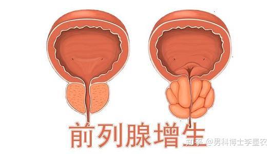 前列腺增生自我治療方法有哪些(前列腺增生自我治療方法)