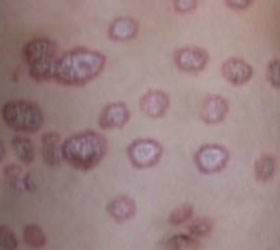 股癬圖片(體癬圖片)