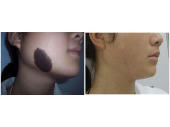 黑色素痣有必要切除嗎圖片（黑色素痣有必要切除嗎）