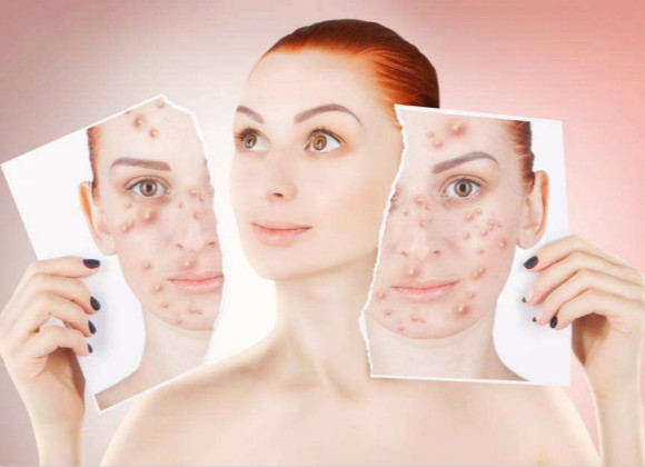 臉過敏紅腫發燙癢怎么快速恢復可以用面膜嗎(臉過敏紅腫發燙癢怎么快速恢復)