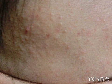 臉上長了好多密密麻麻的小疙瘩還癢（臉上長了好多密密麻麻的小疙瘩）