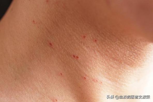 兒童過敏性紫癜的癥狀（過敏性紫癜的癥狀）
