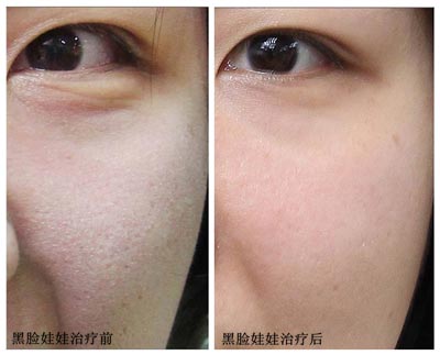 黑臉娃娃有沒有副作用嗎（黑臉娃娃的缺點副作用）