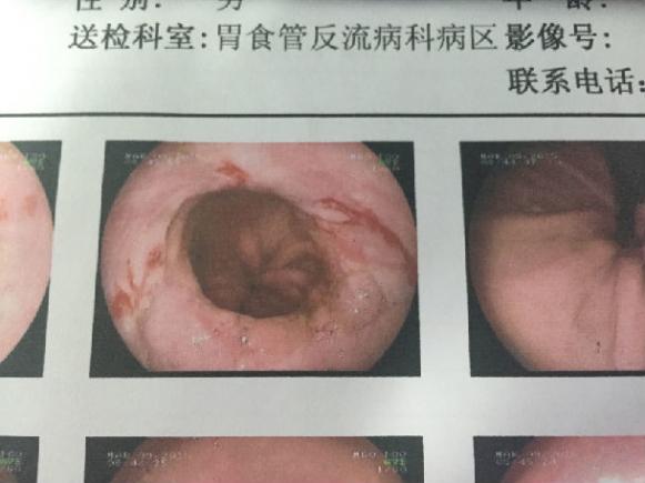 反流性食管炎10種癥狀能自愈(反流性食管炎10種癥狀)